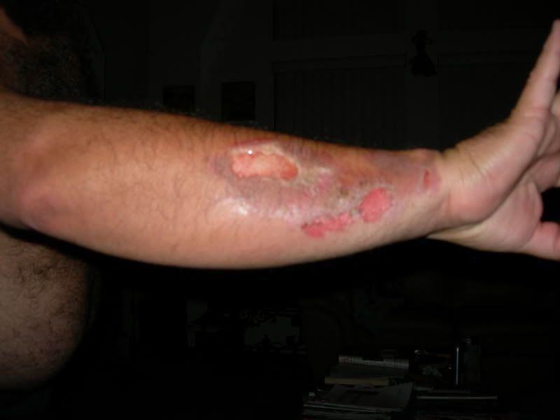 Hot tar burn... Page 2